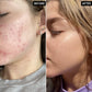 The Inkey List Beta Hydroxy Acid (BHA) Blemish + Blackhead Serum