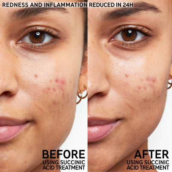 The INKEY List Succinic Acid Acne Treatment