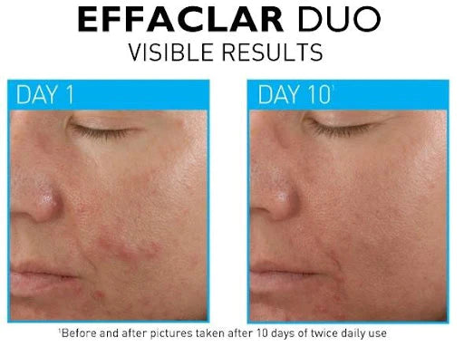 La Roche Posay Effaclar Duo Acne Treatment